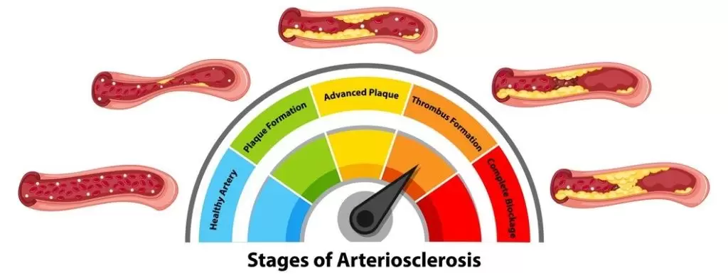Диета при повышенном холестерине Диета при повышенном холестерине