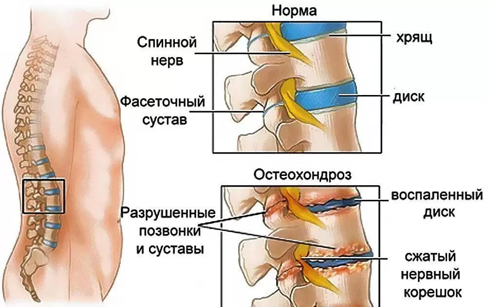 Остеохондроз шейного отдела Остеохондроз шейного отдела