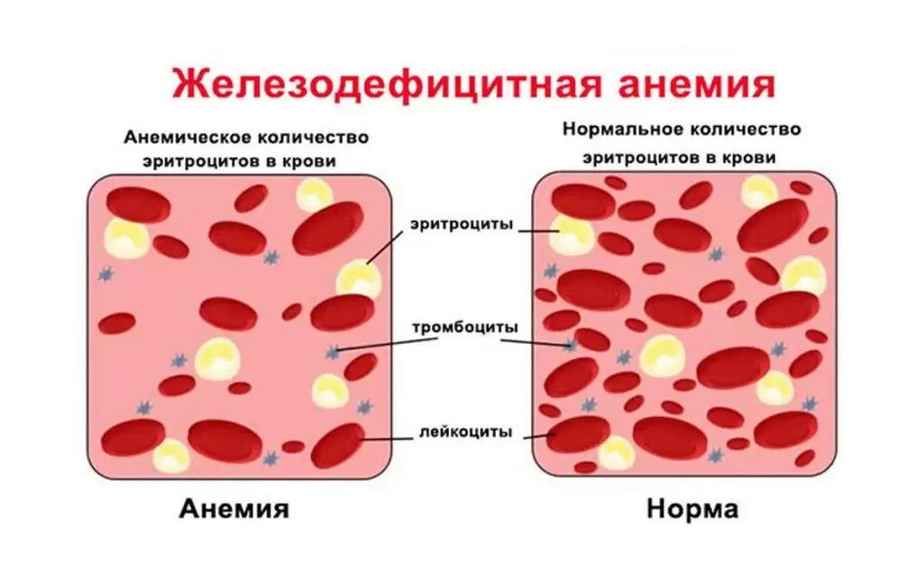 Диета при анемии Диета при анемии
