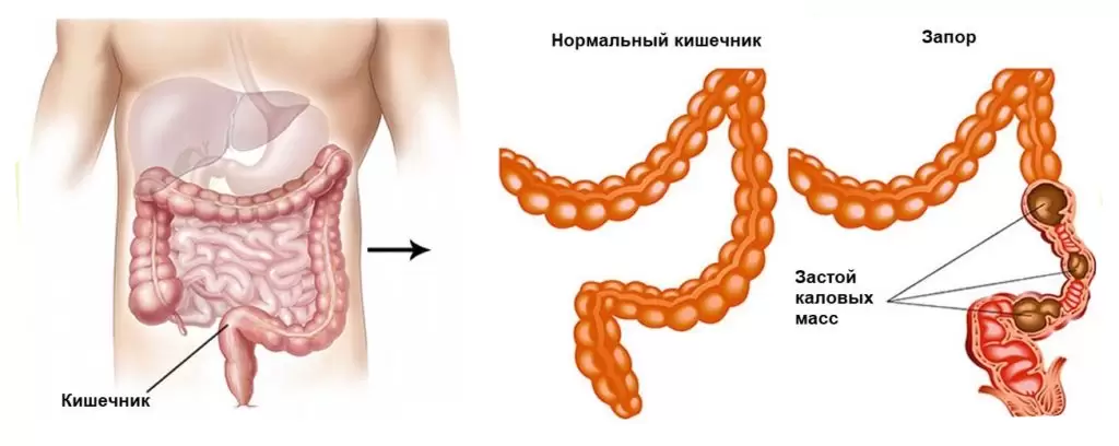 лечение запора у взрослых лечение запора у взрослых