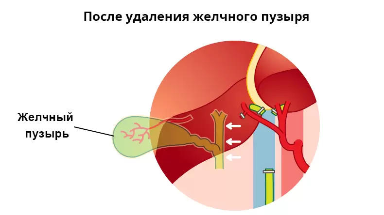 Диета после удаления желчного пузыря с первых дней Диета после удаления желчного пузыря с первых дней