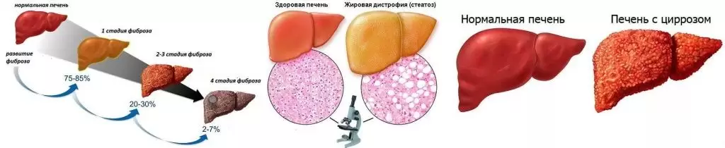 Что можно есть при болезнях печени Что можно есть при болезнях печени